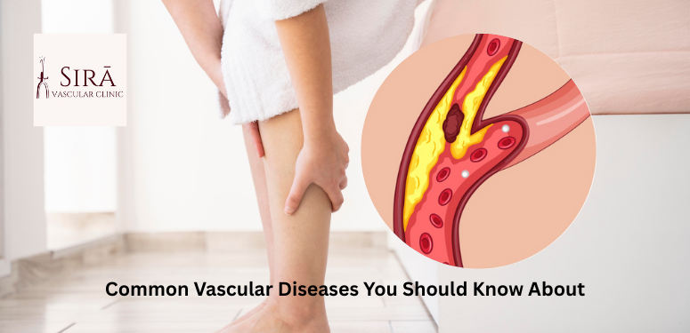 Common Vascular Diseases and When to See a Vascular Surgeon