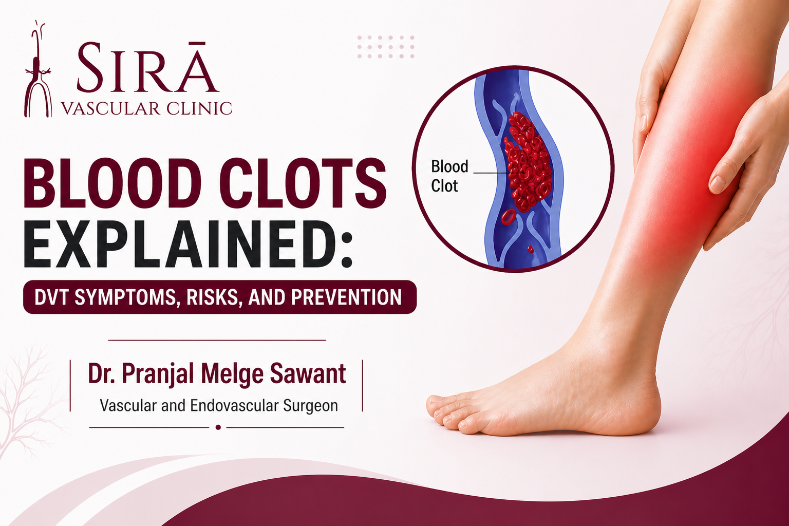 Blood Clots Explained: DVT Symptoms, Risks, and Prevention