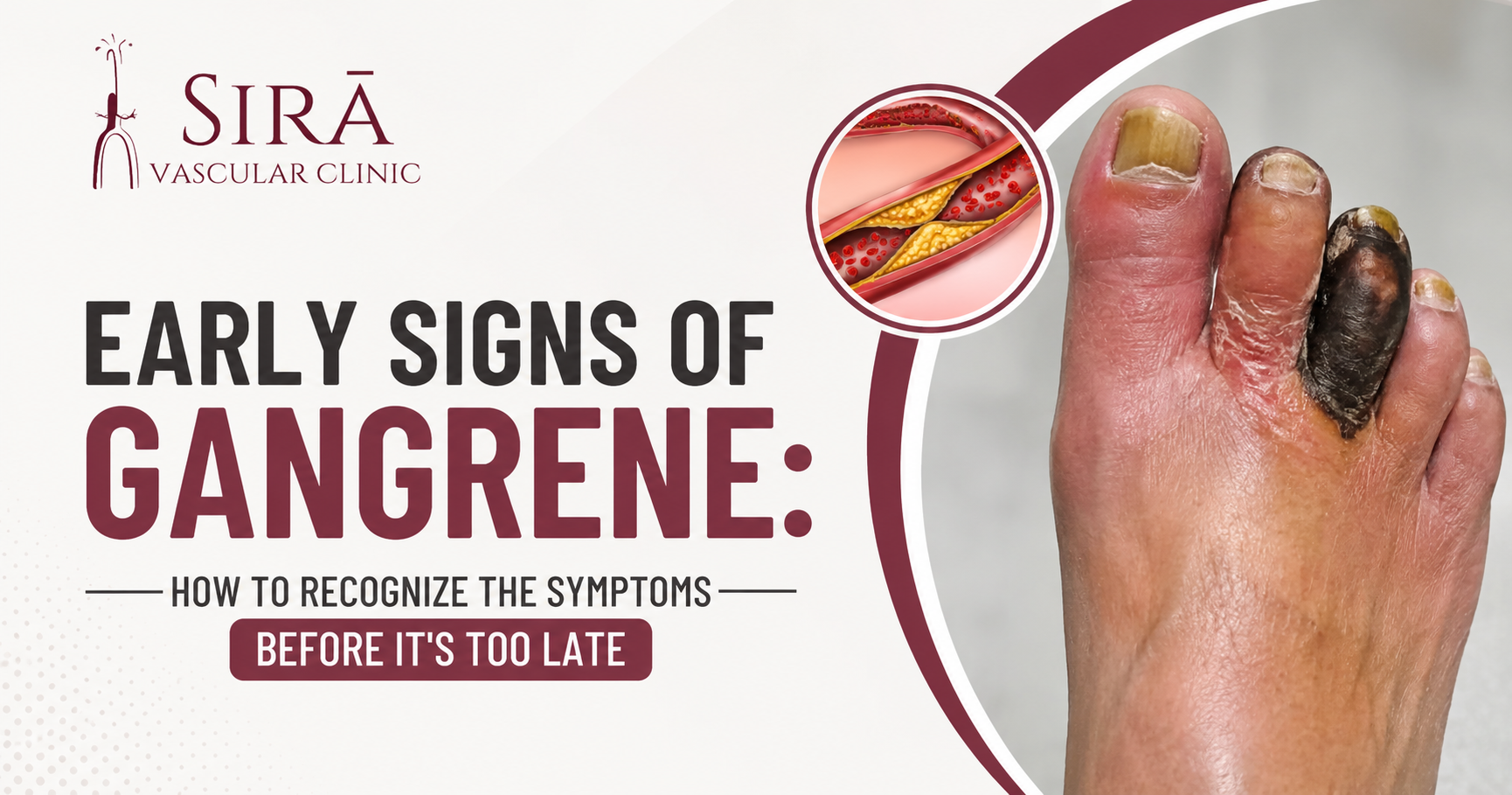 Early Signs of Gangrene: How to Recognize the Symptoms Before It’s Too Late