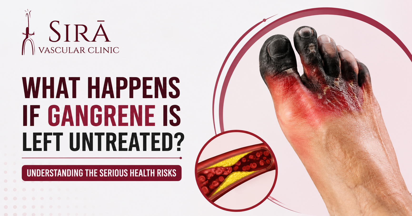 What Happens If Gangrene Is Left Untreated? Understanding the Serious Health Risks