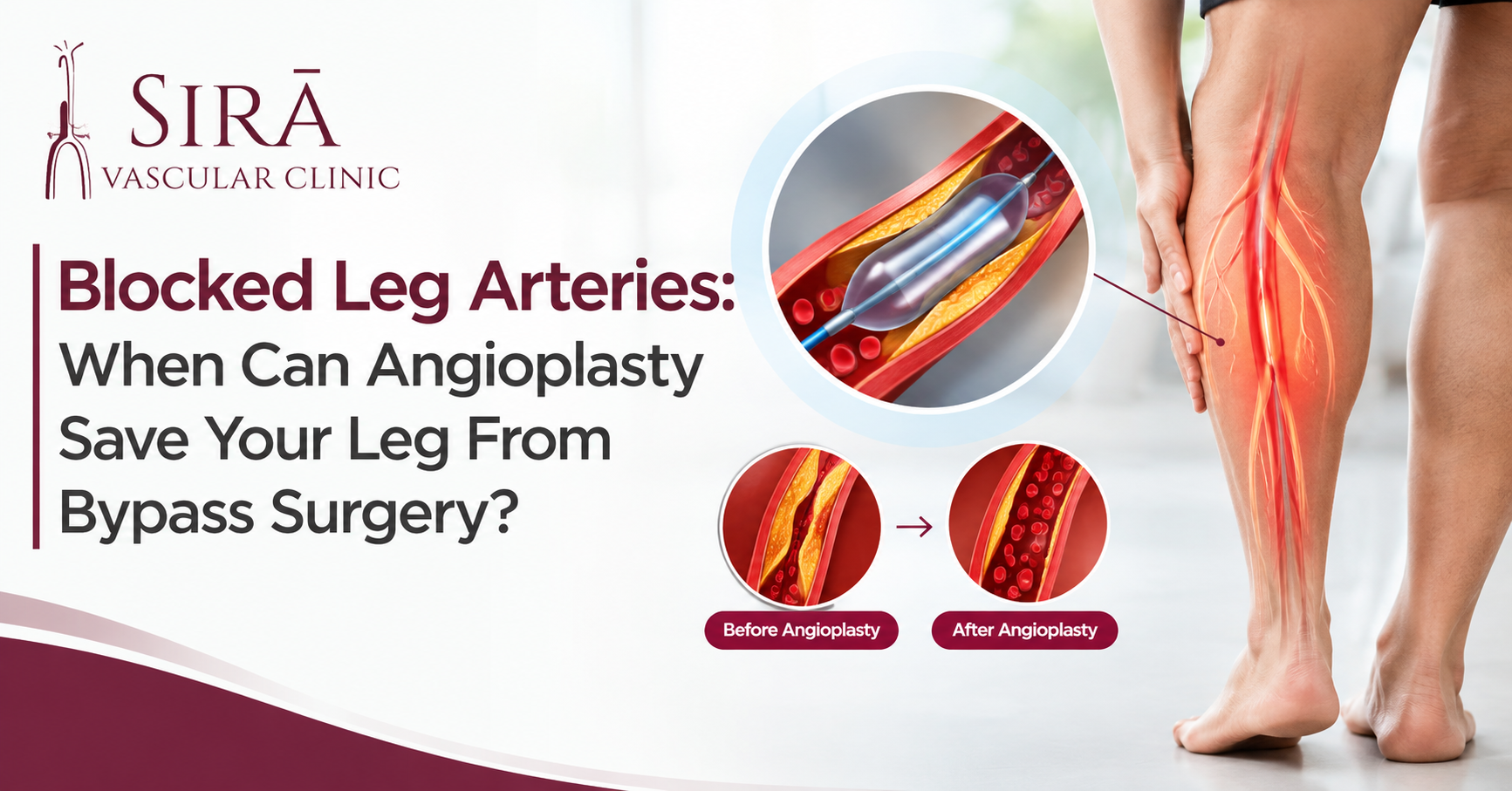 Blocked Leg Arteries: When Can Angioplasty Save Your Leg From Bypass Surgery?