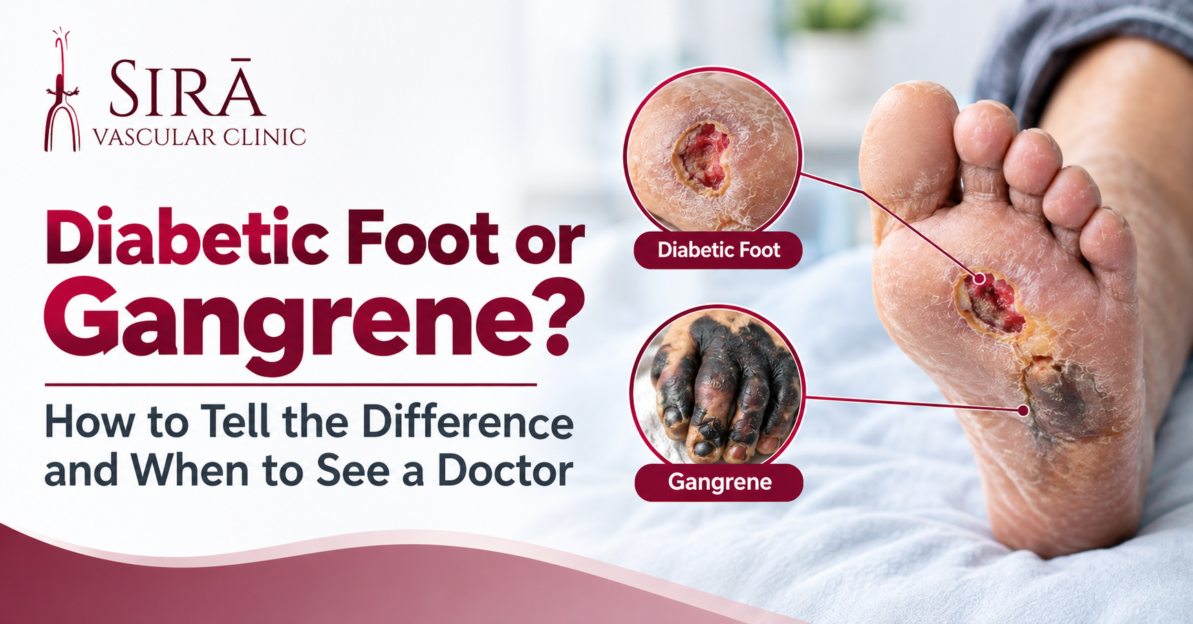Diabetic Foot or Gangrene? How to Tell the Difference and When to See a Doctor